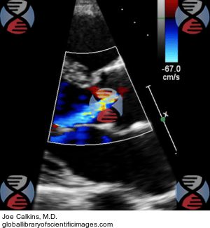 aortic regurgitation echo