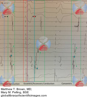 intracardiac electrogram atrioventricular avrt paced ablation alternating conduction