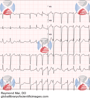 wandering atrial pacemaker rhythm strip