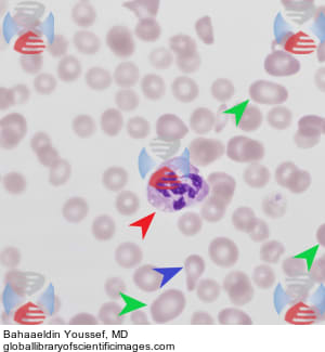 megaloblastic anemia peripheral smear