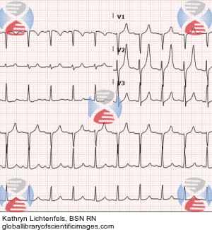 peaked t waves in hyperkalemia