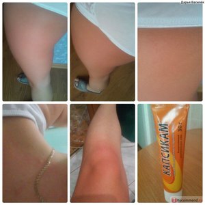 Капсикам на растяжки использование Капсикам на растяжки
