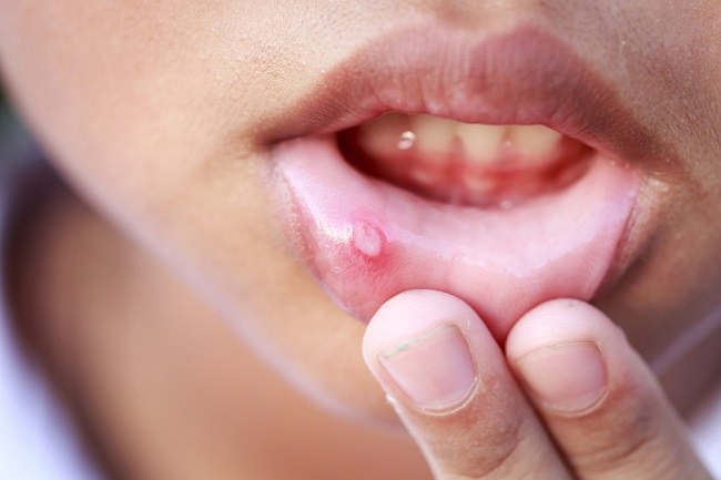 Sariawan di Bibir Ternyata Bisa Disebabkan Banyak Penyakit - alodokter