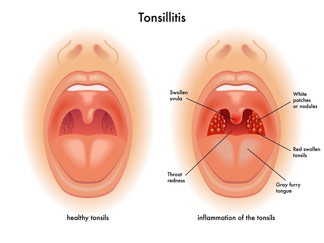 Tonsilitis Patofisiologi Diagnosis Penatalaksanaan Alomedika