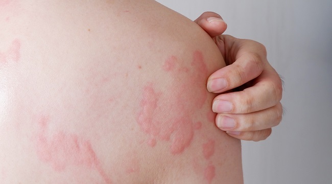 Alergi Dingin Penyebab Ciri Ciri Obat Dan Cara Mencegahnya Riset