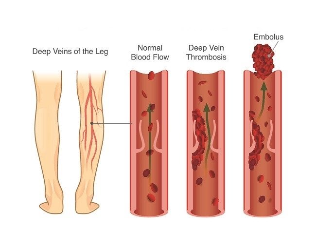 Deep Vein Thrombosis Gejala Penyebab Dan Mengobati Alodokter