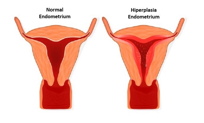 Hiperplasia Endometrium Patofisiologi Diagnosis Penatalaksanaan 216090