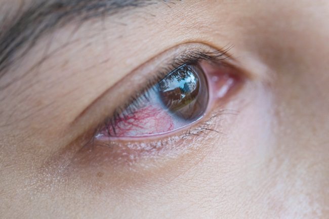 Mata Merah Sebelah Kenali Penyebab Dan Pencegahannya Alodokter