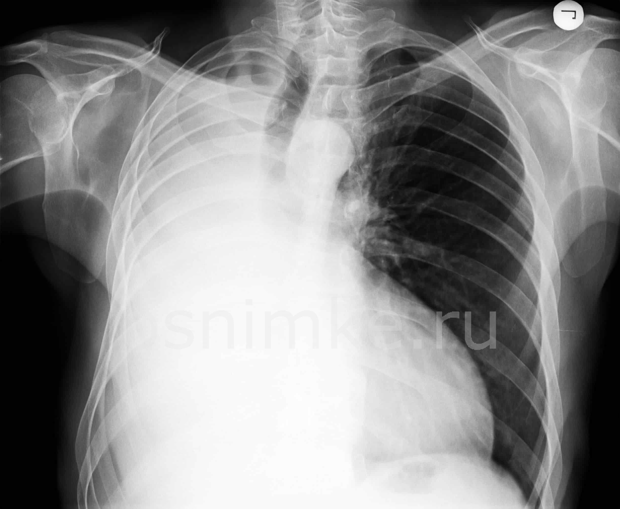 воспаление легких на снимке рентгена фото