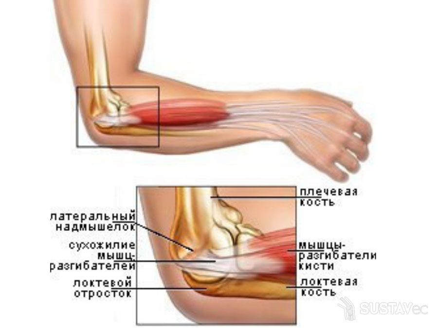 Тендинит двуглавой мышцы локтя