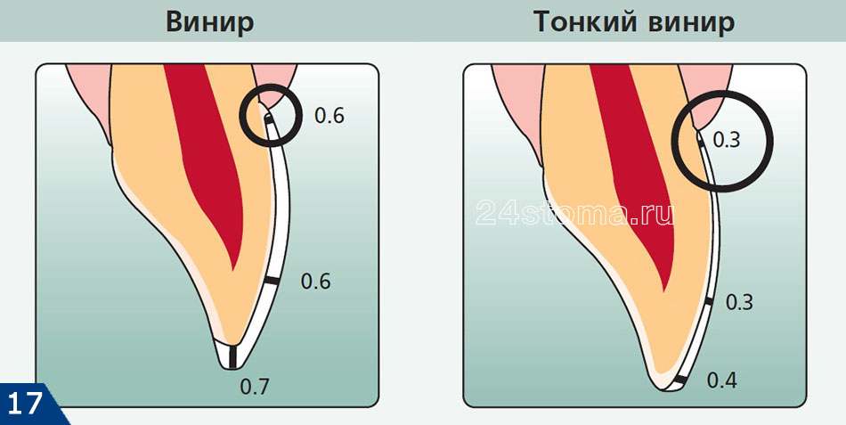 Толщина стандартных и тонких виниров