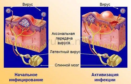 Как возникает вирус герпеса