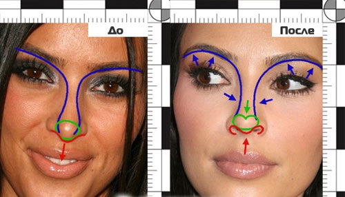 Фото Кардашьян до и после ринопластики с пометками пластического хирурга