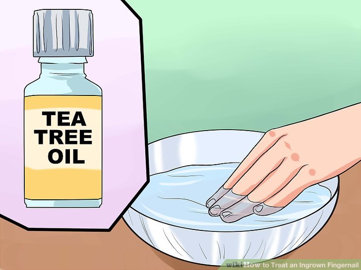 Image titled Treat an Ingrown Fingernail Step 7