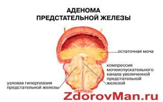 Лечение аденомы простаты народными средствами