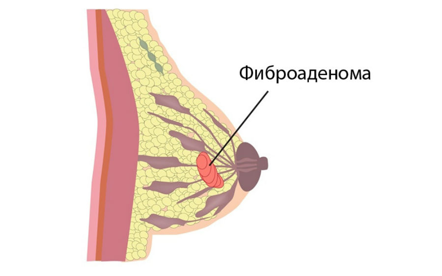 Фиброаденома