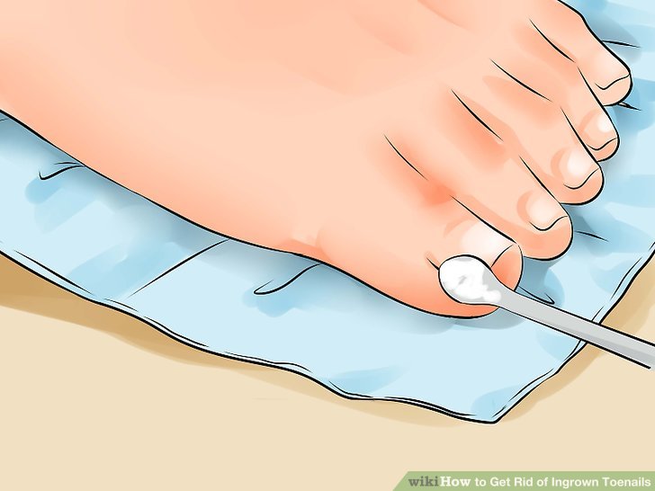 Image titled Remove an Ingrown Toenail Step 7
