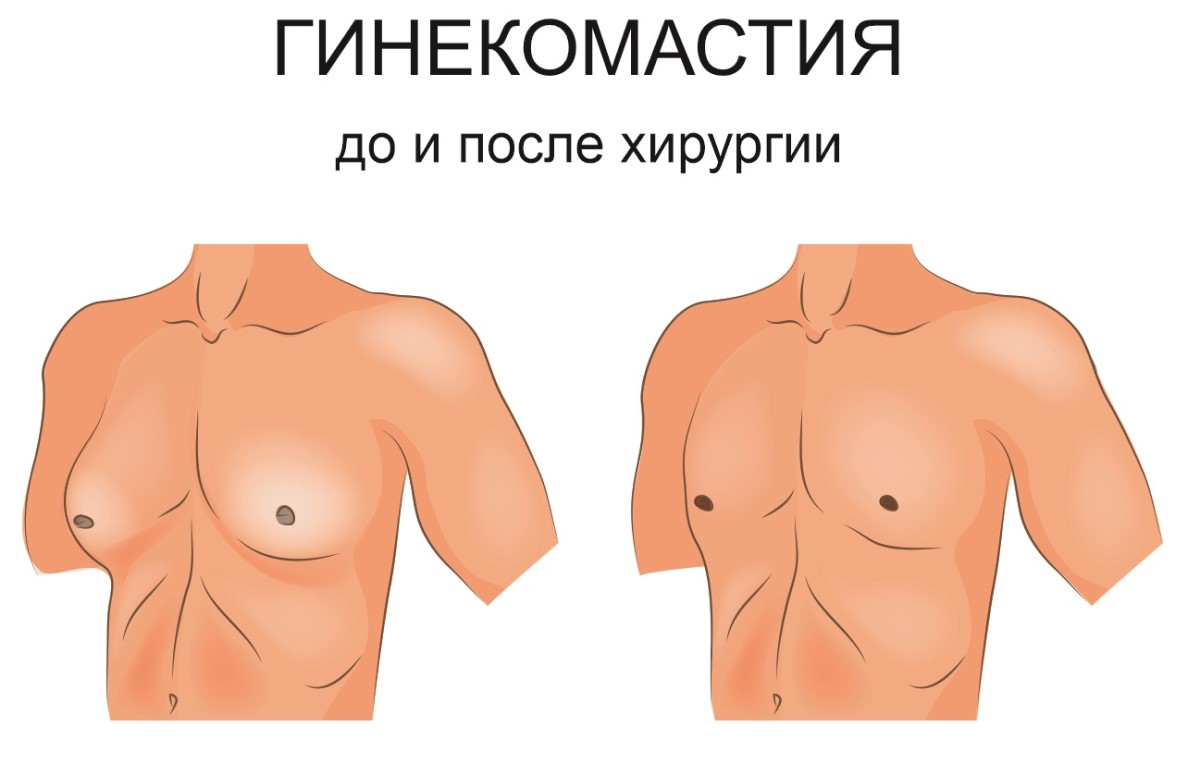 Гинекомастия молочной железы