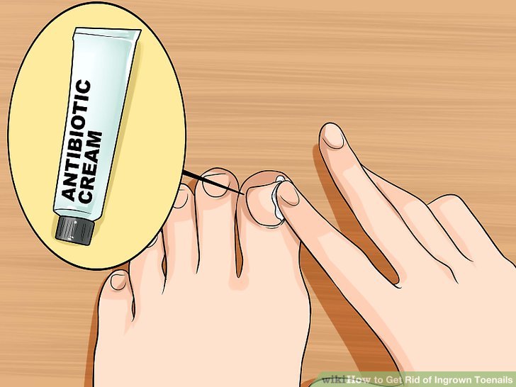 Image titled Relieve Ingrown Toe Nail Pain Step 18