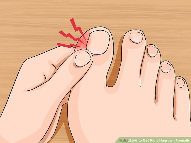 Image titled Relieve Ingrown Toe Nail Pain Step 2