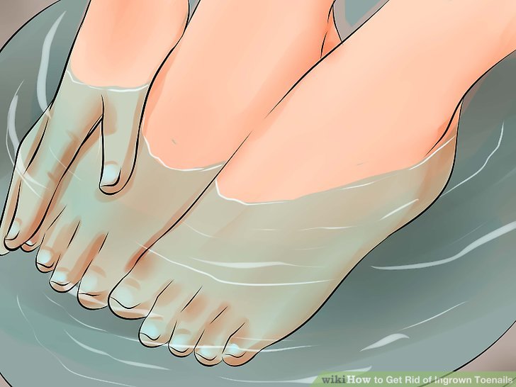 Image titled Remove an Ingrown Toenail Step 1