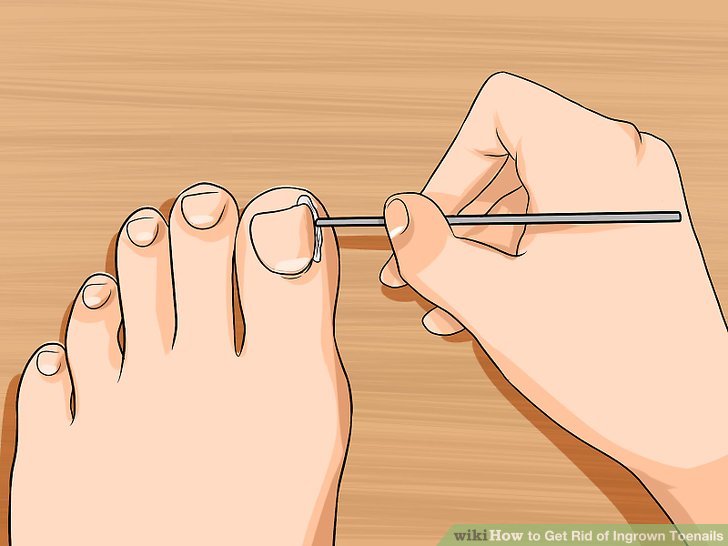 Image titled Relieve Ingrown Toe Nail Pain Step 17