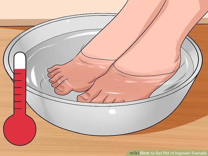 Image titled Get Rid of Bunions Step 7