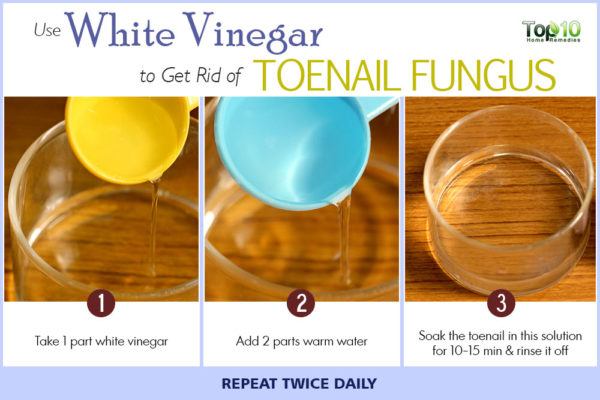 white vinegar for toenail fungus