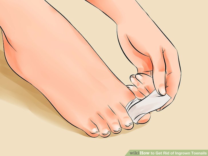 Image titled Remove an Ingrown Toenail Step 17