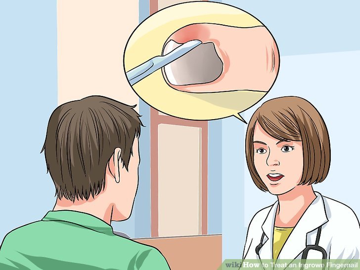 Image titled Treat an Ingrown Fingernail Step 9