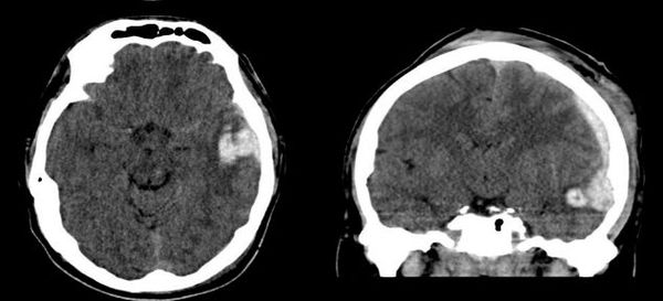 Ушиб головного мозга на КТ