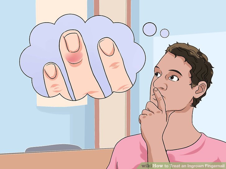 Image titled Treat an Ingrown Fingernail Step 11