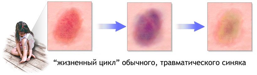 Степени синяка Степени гематомы