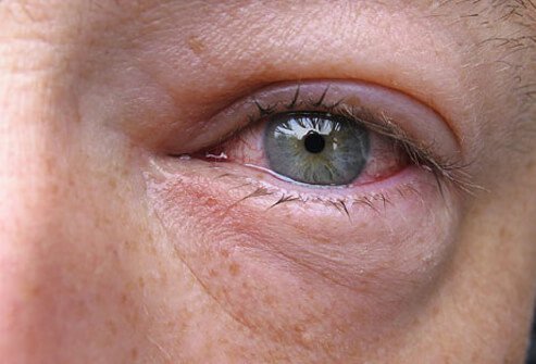 A close-up view of heavy inflammation in the eye.