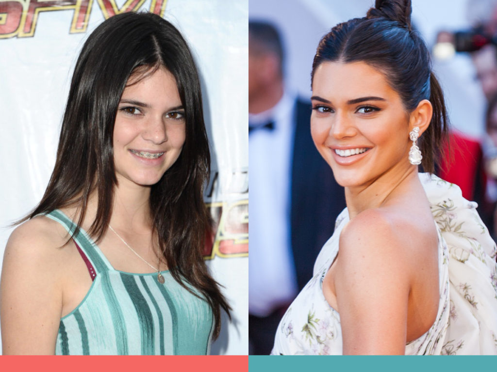 Kendall Jenner braces