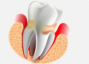 схематическое описание периодонтита