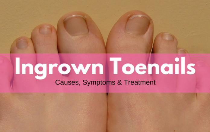 Ingrown toenails symptom causes Ingrown toenails symptom causes