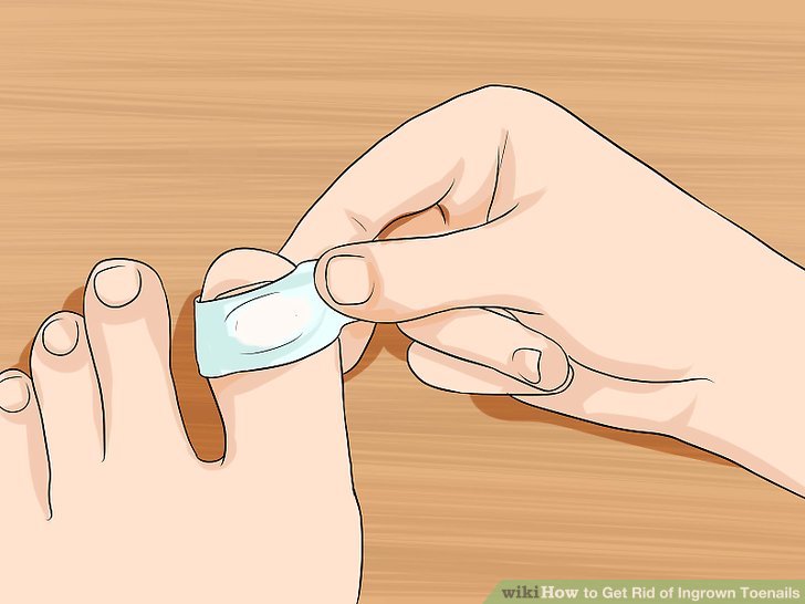 Image titled Relieve Ingrown Toe Nail Pain Step 11