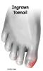Ingrown Toenail