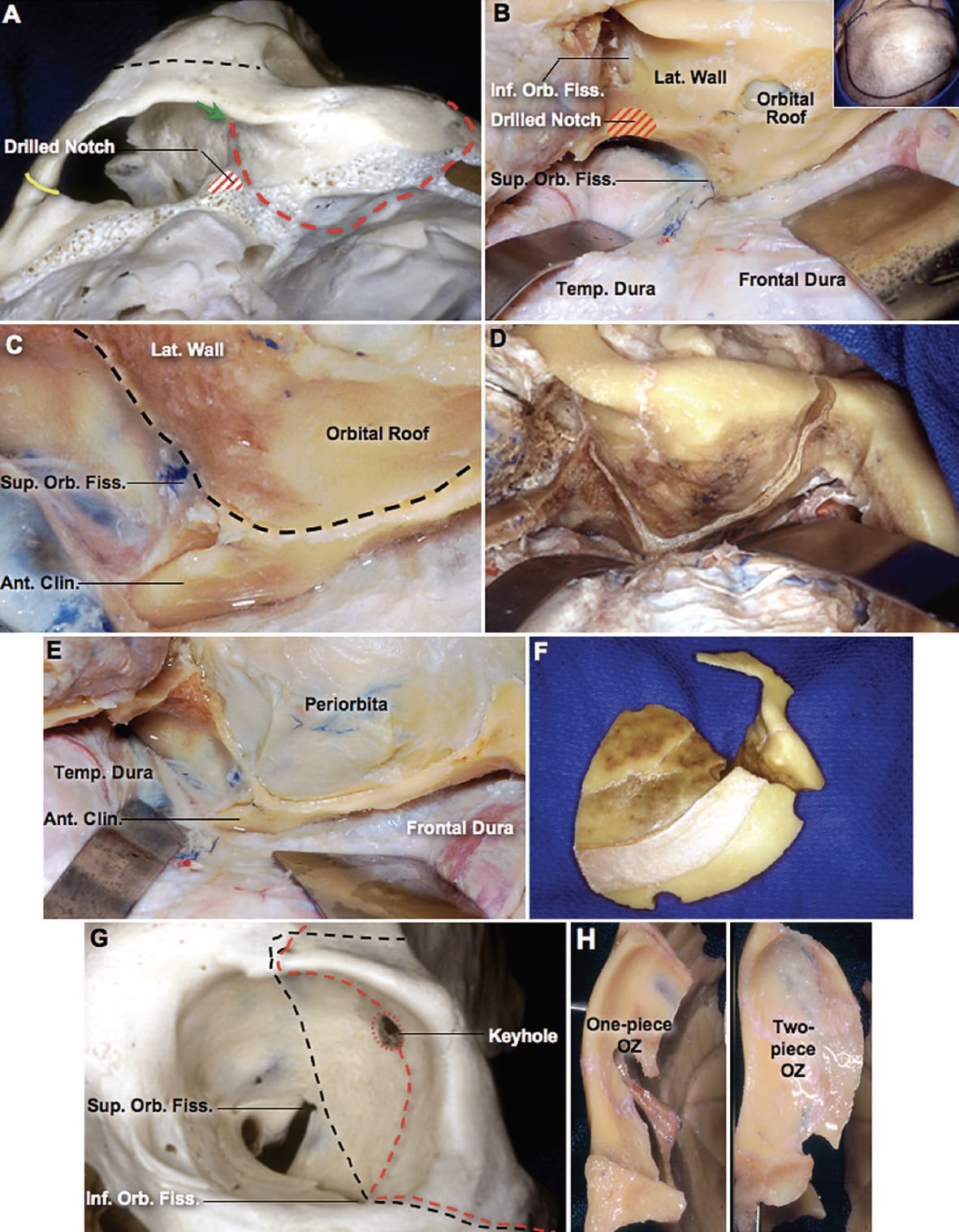 Two-Piece OZ Craniotomy | Neuroanatomy | The Neurosurgical Atlas