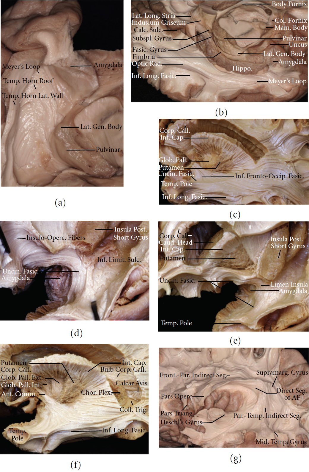 Views of the Temporal Horn and Temporal Subcortical Structures 