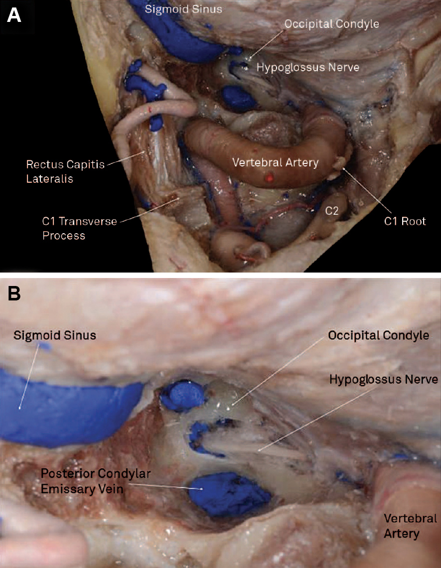 【おすすめ】 The The | Neuroanatomy | Craniotomy Retrosigmoid 医学一般