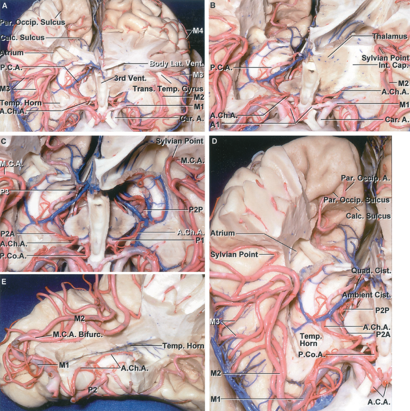 Superior Views of the Cerebral Arteries | Neuroanatomy | The