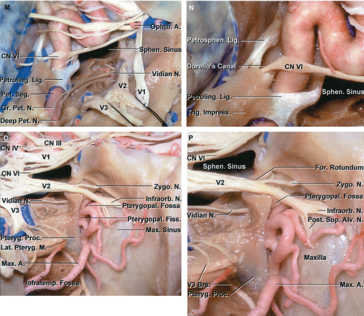 洋書 Anatomy and Surgery of the Cavernous Sin Cavernous Sinus | Complete Anatomy