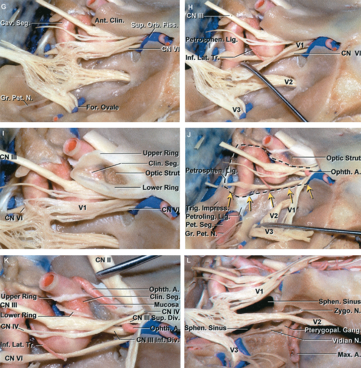 洋書 Anatomy and Surgery of the Cavernous Sin Surgical Anatomy of the Cavernous Sinus | SpringerLink