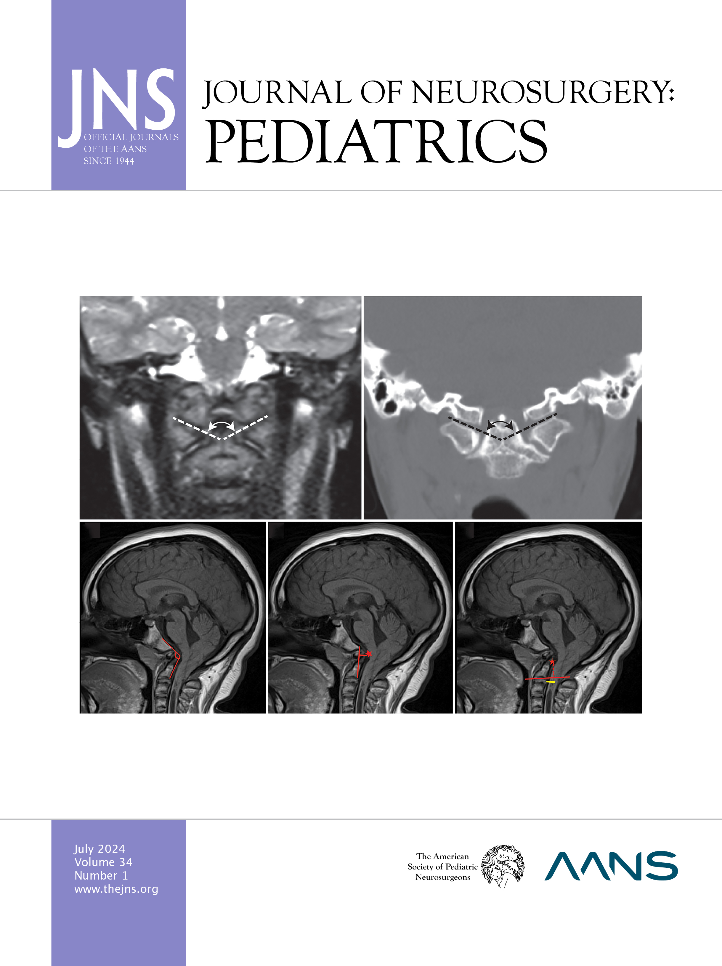 新 NS NOW Neurosurgical ReOperations Neurosurgical Focus - Spine Section