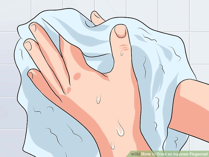 Image titled Treat an Ingrown Fingernail Step 14