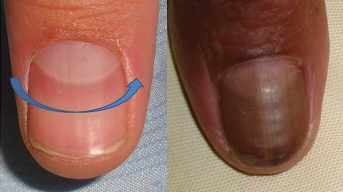 No Moons on Fingernails