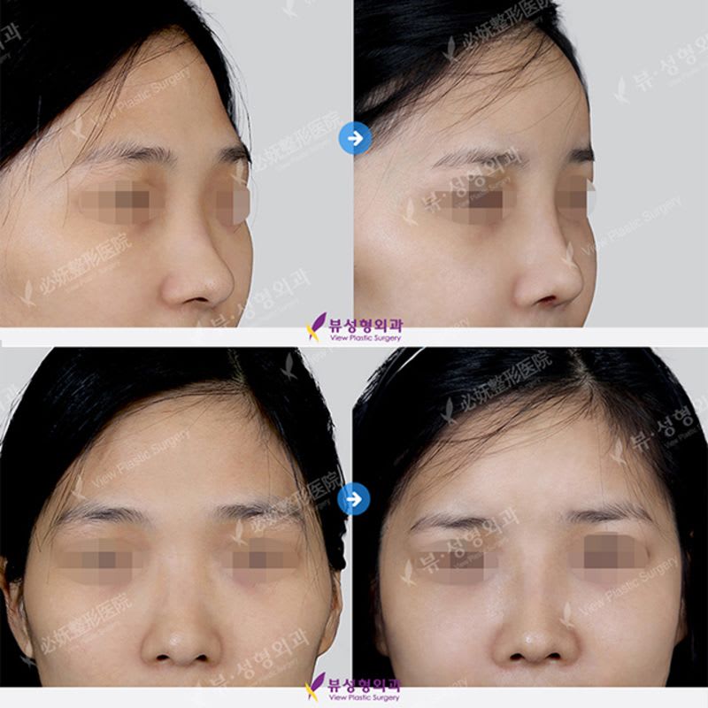 Openbaymed Doll Line Nose Filler