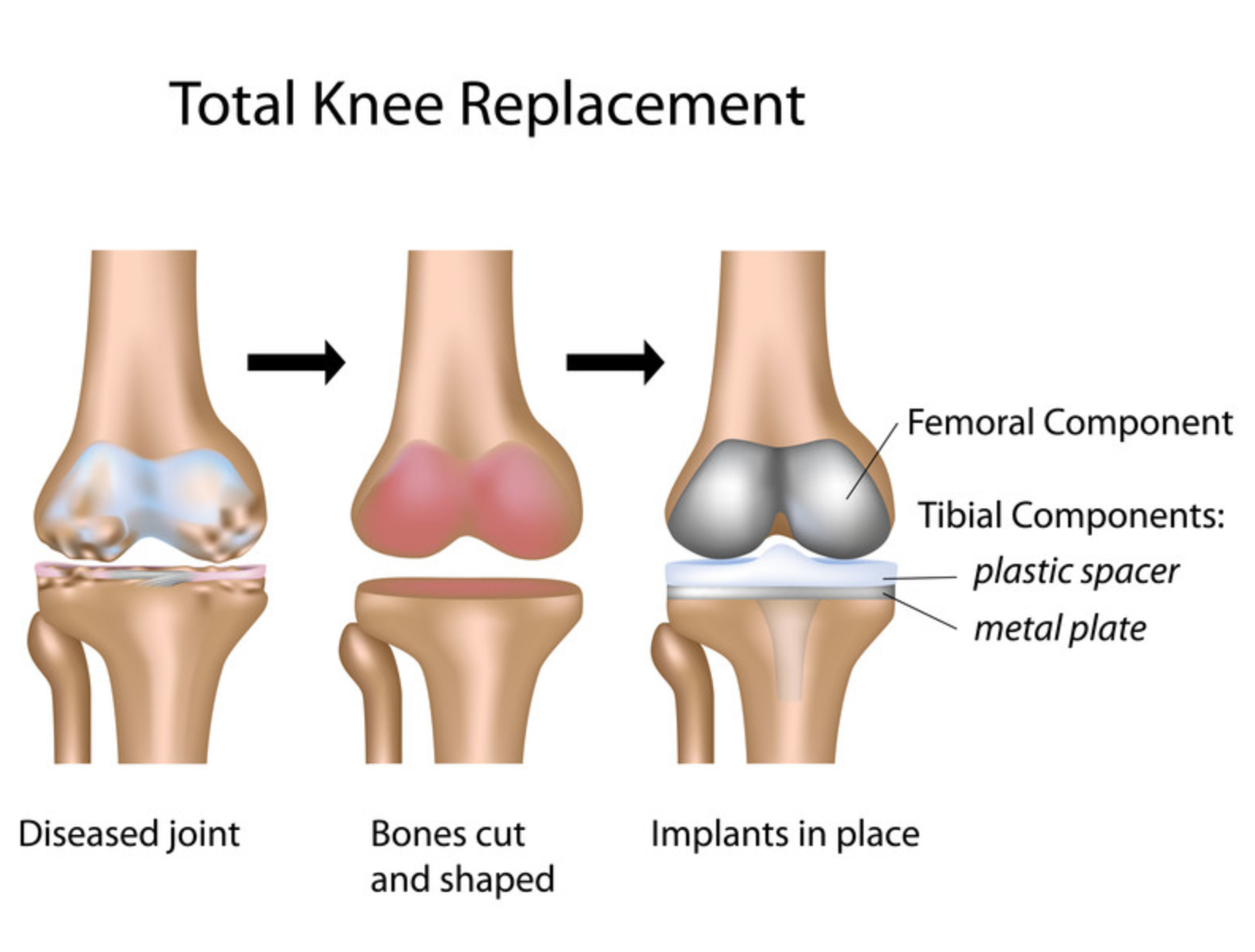 Knee replacement Singapore